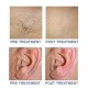 Permanent hair removal at your home with Laser EH002